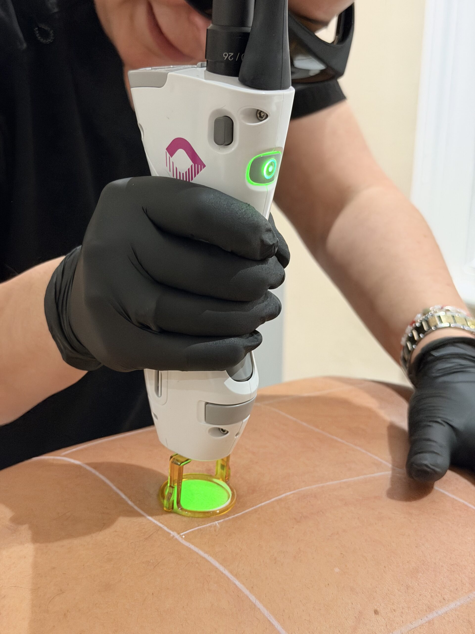 Laser Hair Removal - Before treatment