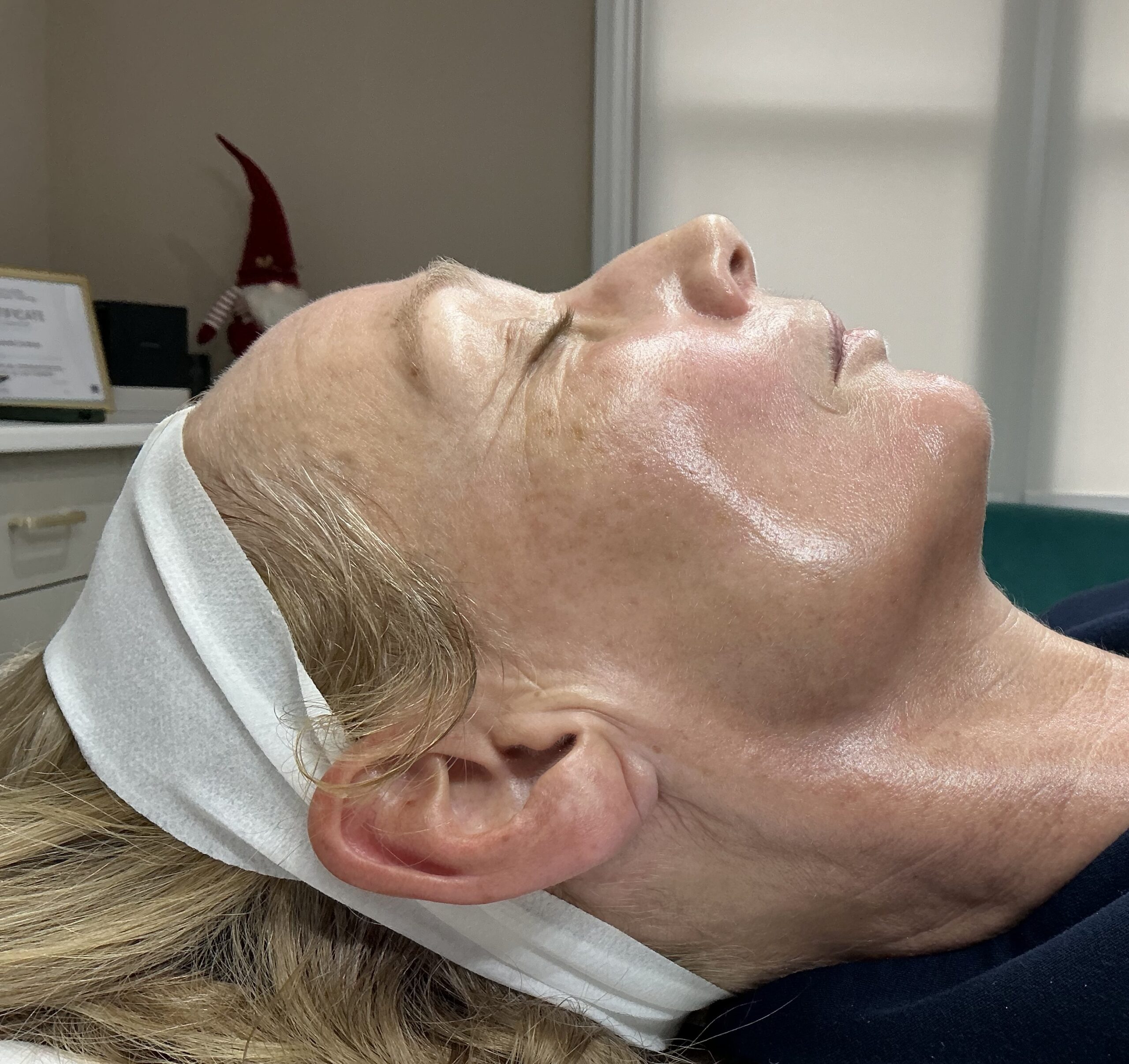 AlumierMD Chemical Peels