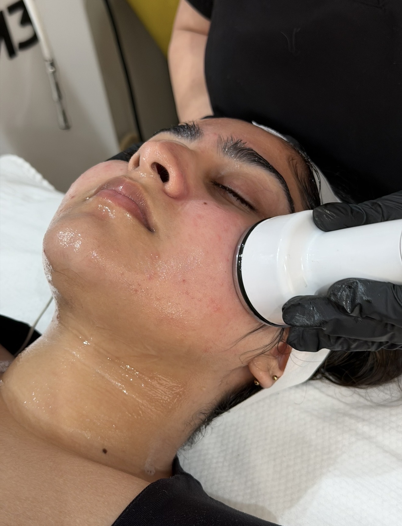 Aquaderm No-Needle Mesotherapy