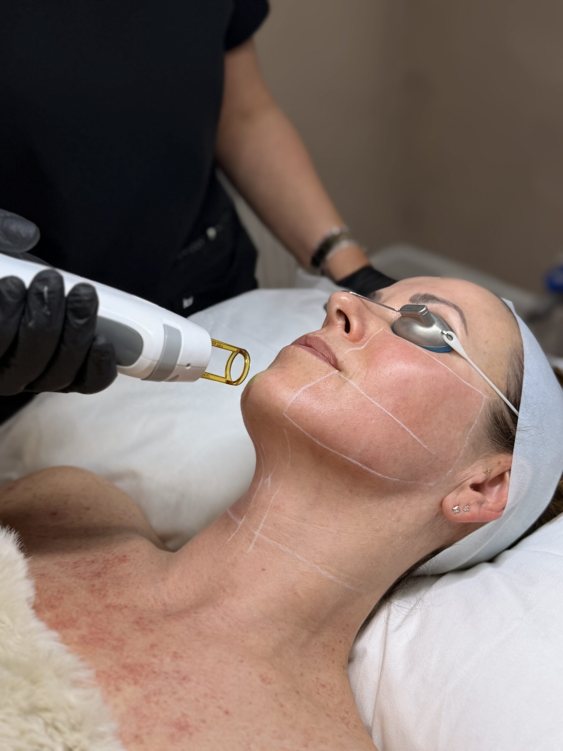 Laser Skin Resurfacing