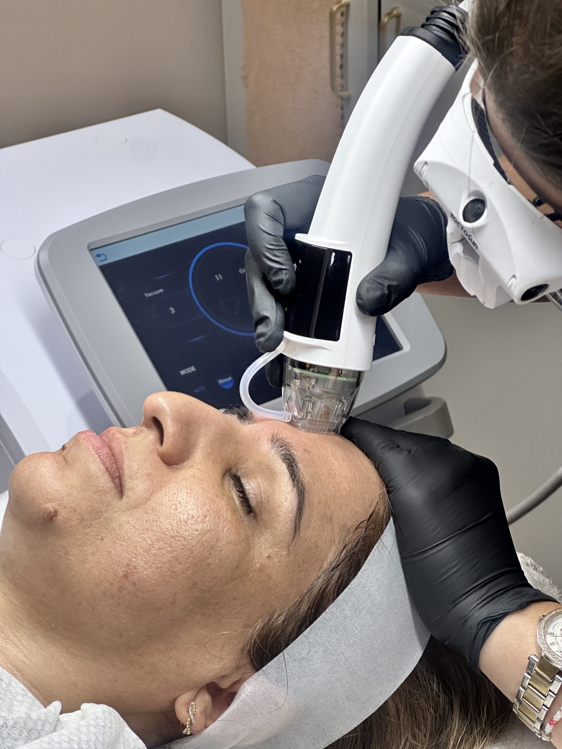 RF Microneedling