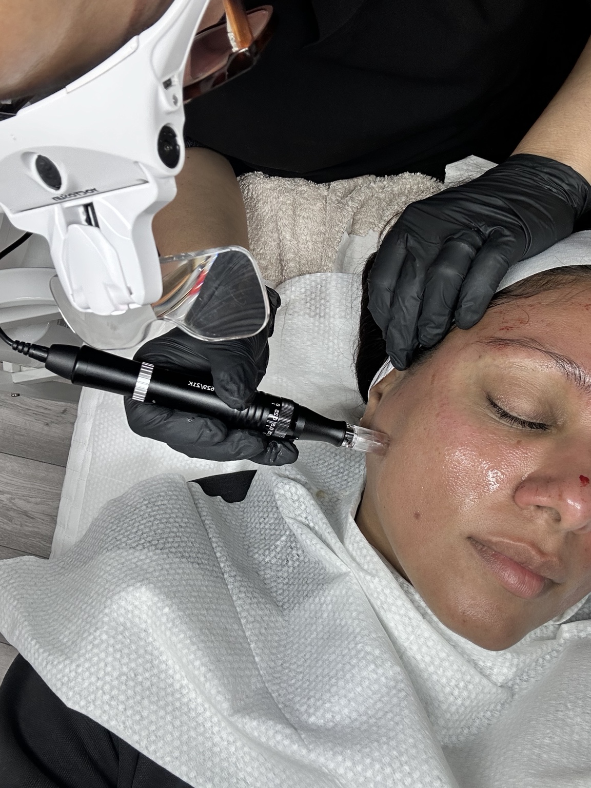 RF microneedling clinical treatment performed safely on deeper skin tone