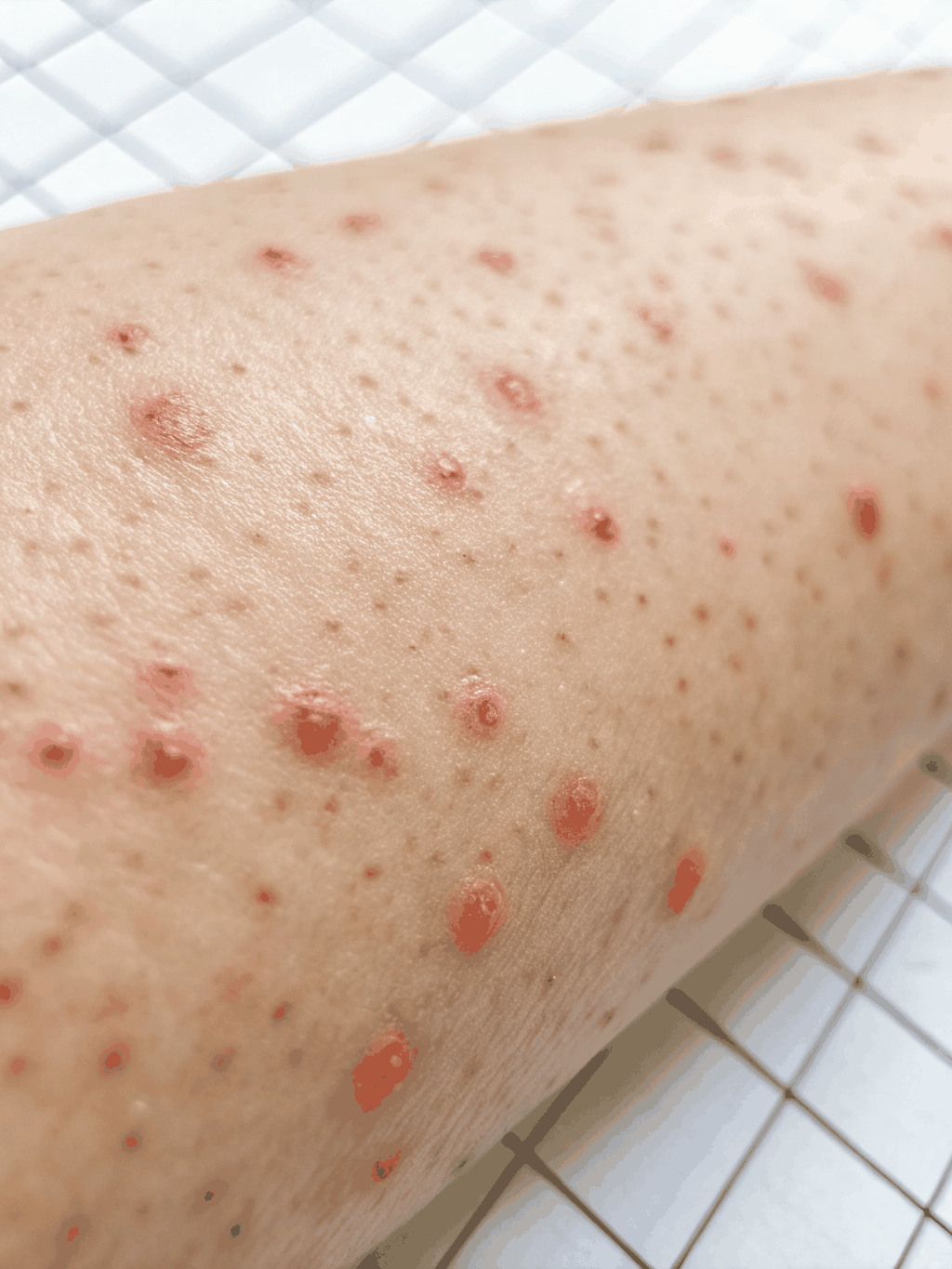 Cherry Angiomas