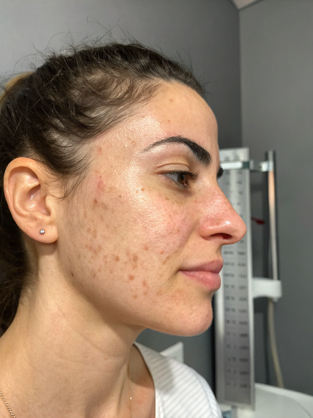 Dermal Naevus