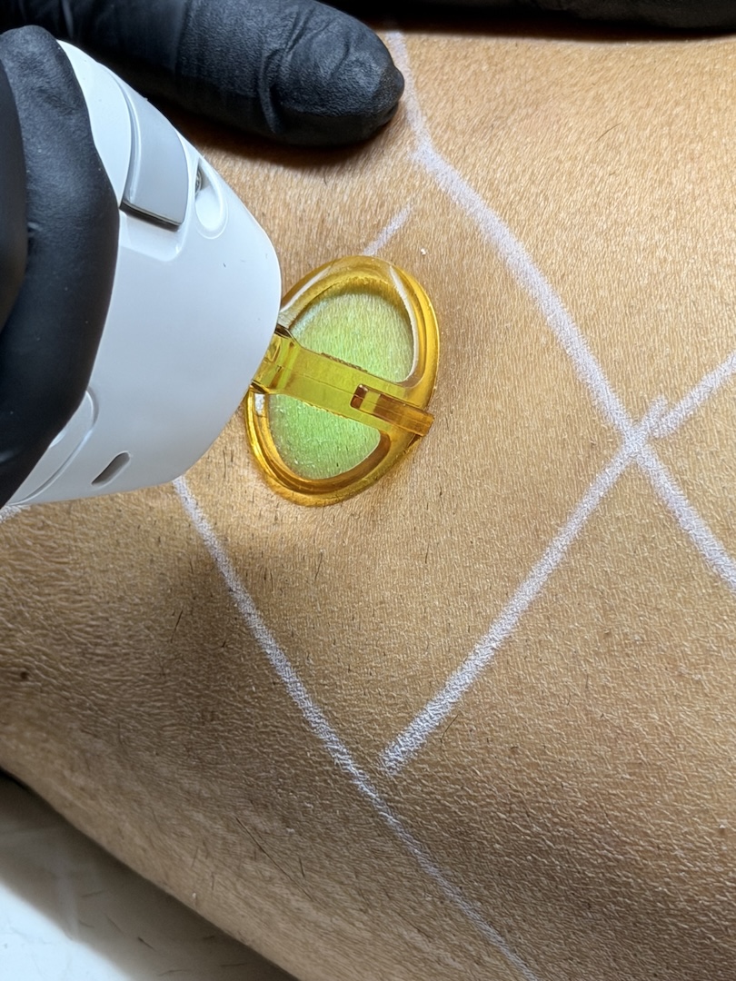 Laser Hair Removal