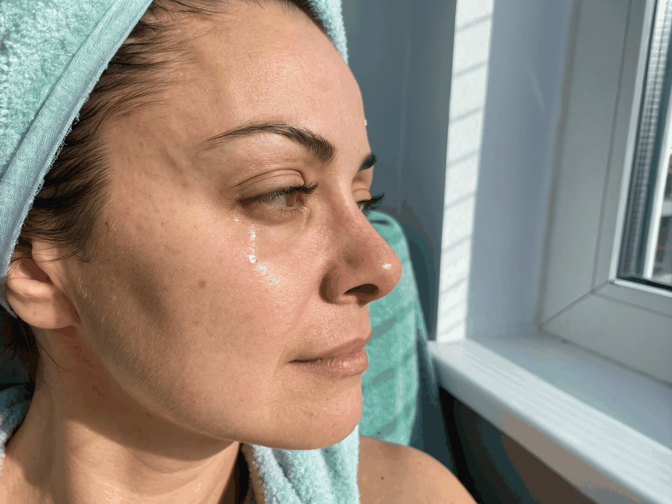 Tear trough dermal filler treatment for under-eye hollows and dark circles
