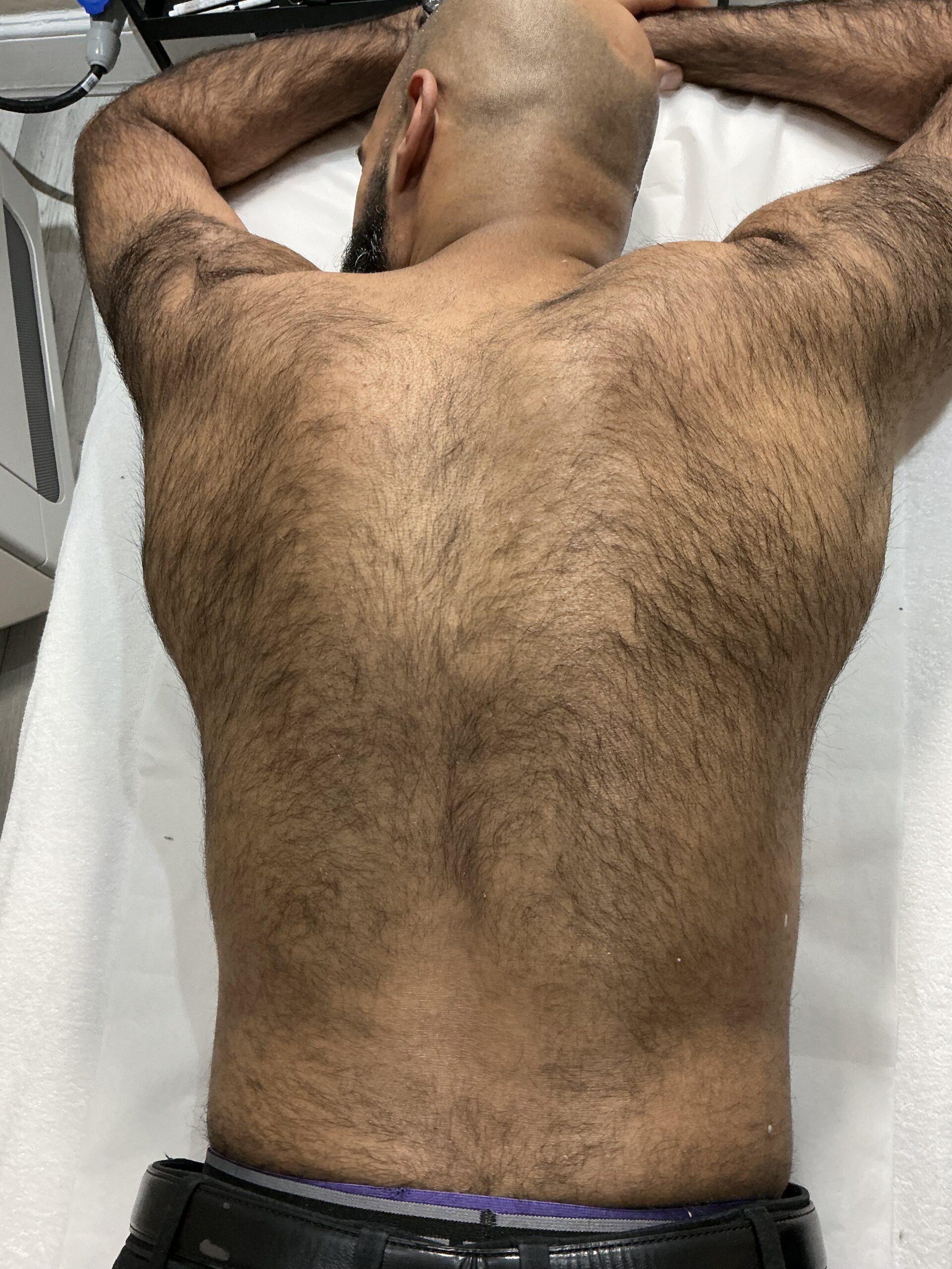 Laser Hair Removal - Before treatment
